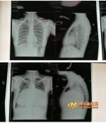 上图为正常人的胸部CT。下图为张女士的胸部CT，可以看到，她的心脏几乎占满左右胸腔。 - News.Sina.com.Cn