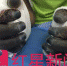 ▲5月28日，红星新闻记者在加德满都一家高级医院见到了被救的桑吉，他的十个手指头可能难以保留 - News.Sina.com.Cn