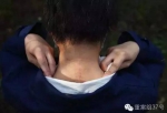 八达岭老虎咬人事件伤者：伤疤在撕扯也在缝合 - News.Sina.com.Cn